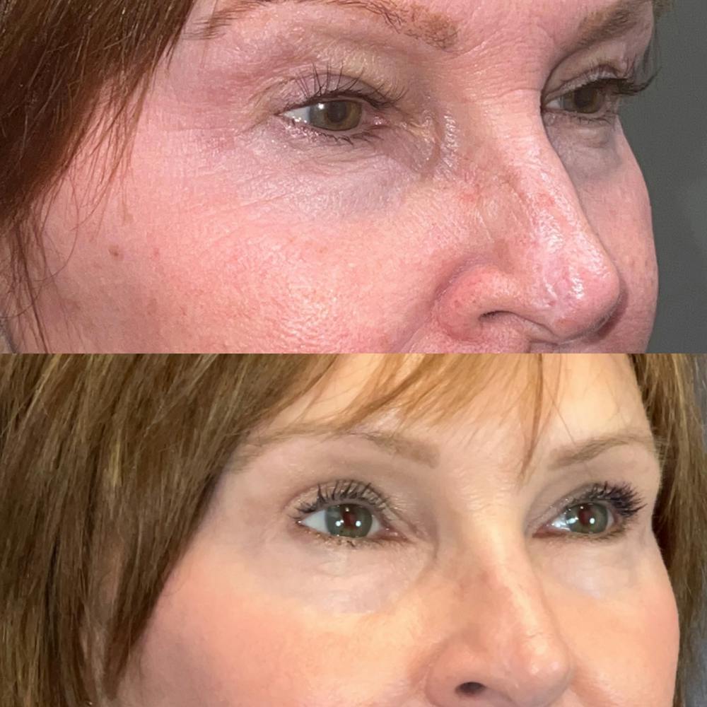 Upper Blepharoplasty Before & After Gallery - Patient 166803369 - Image 3