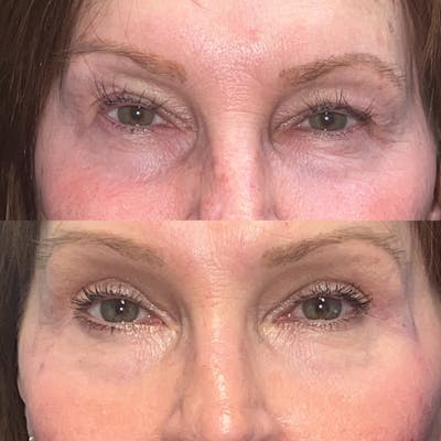Upper Blepharoplasty Before & After Gallery - Patient 166803369 - Image 1