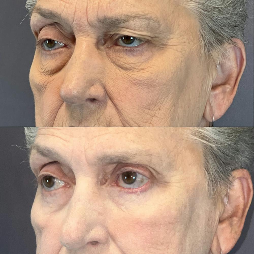 Lower Blepharoplasty Before & After Gallery - Patient 166803390 - Image 2