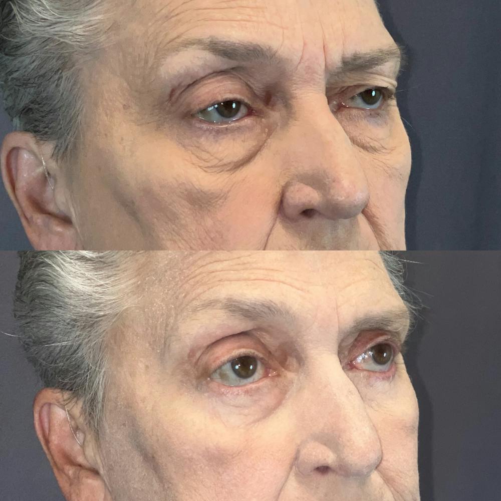 Laser Resurfacing Before & After Gallery - Patient 166803669 - Image 3
