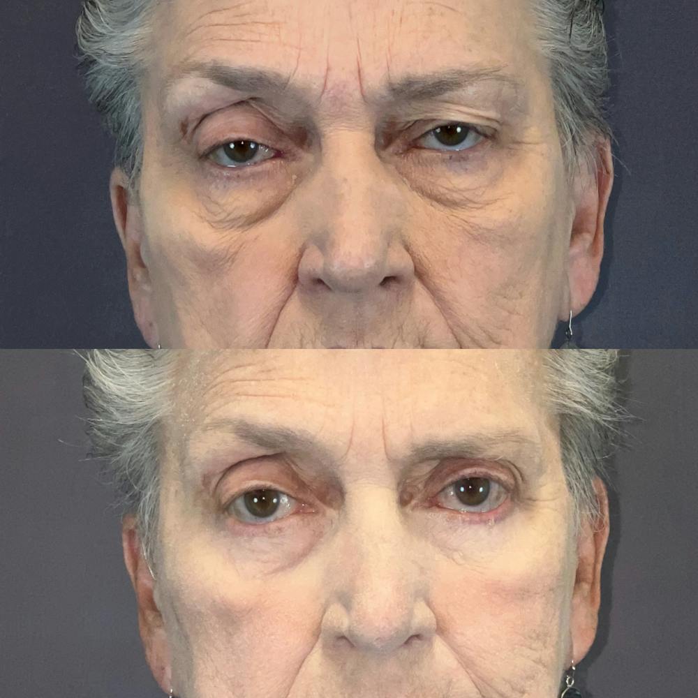 Upper Blepharoplasty Before & After Gallery - Patient 166803381 - Image 1