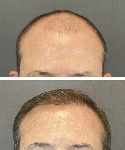 Hair Restoration  Before & After Gallery - Patient 141758557 - Image 1