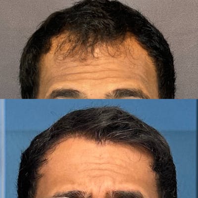 Hair Restoration  Before & After Gallery - Patient 174095570 - Image 1