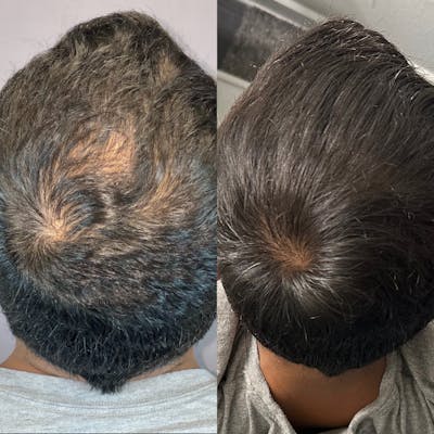 Hair Restoration  Before & After Gallery - Patient 174095570 - Image 2