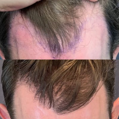 Hair Restoration  Before & After Gallery - Patient 179369555 - Image 2