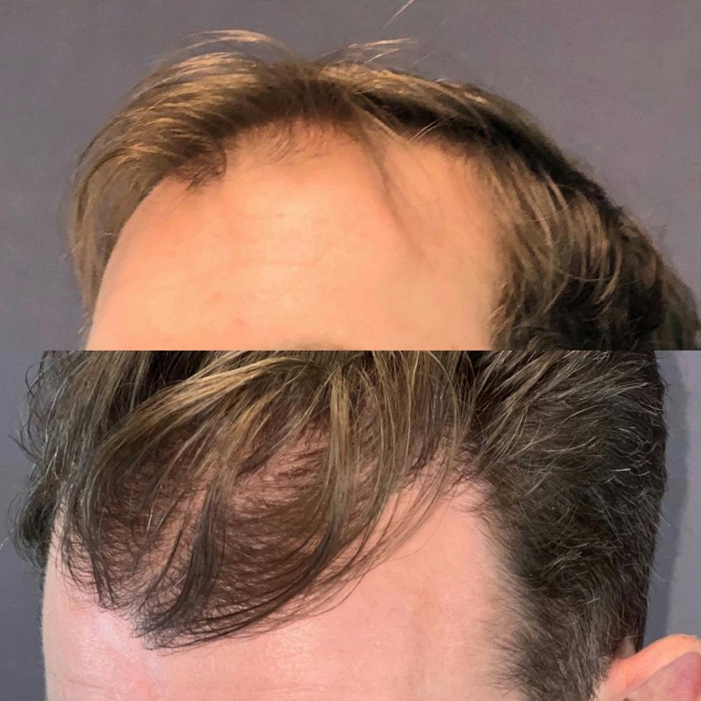 Hair Restoration  Before & After Gallery - Patient 179369555 - Image 3