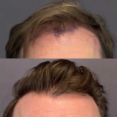 Hair Restoration  Before & After Gallery - Patient 179369555 - Image 1