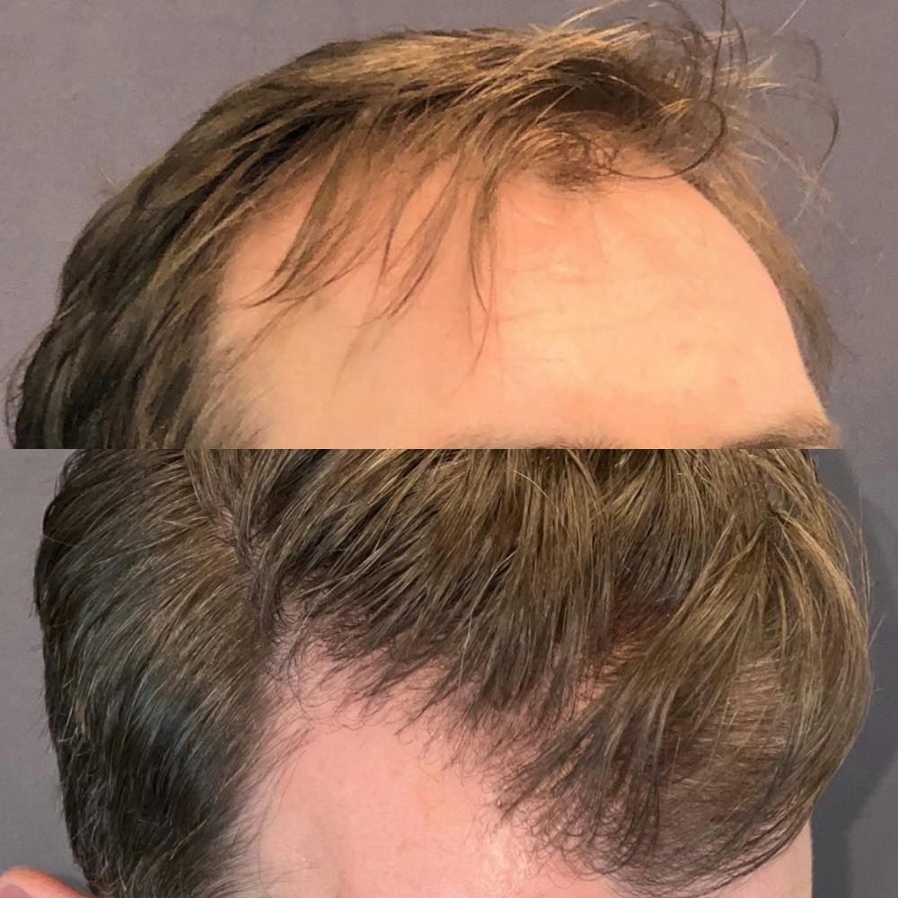 Hair Restoration  Before & After Gallery - Patient 179369555 - Image 4
