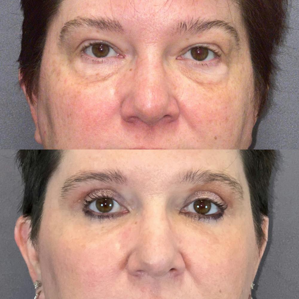 Lower Blepharoplasty Before & After Gallery - Patient 179369839 - Image 1