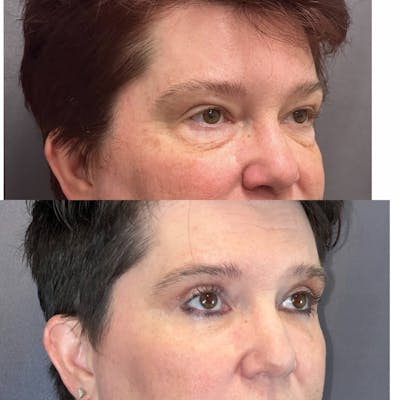 Lower Blepharoplasty Before & After Gallery - Patient 179369839 - Image 2