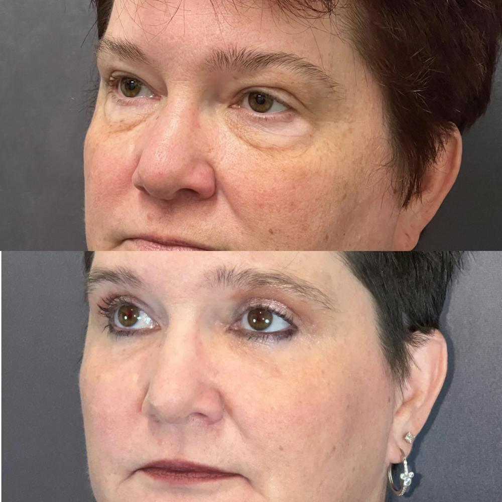 Lower Blepharoplasty Before & After Gallery - Patient 179369839 - Image 3