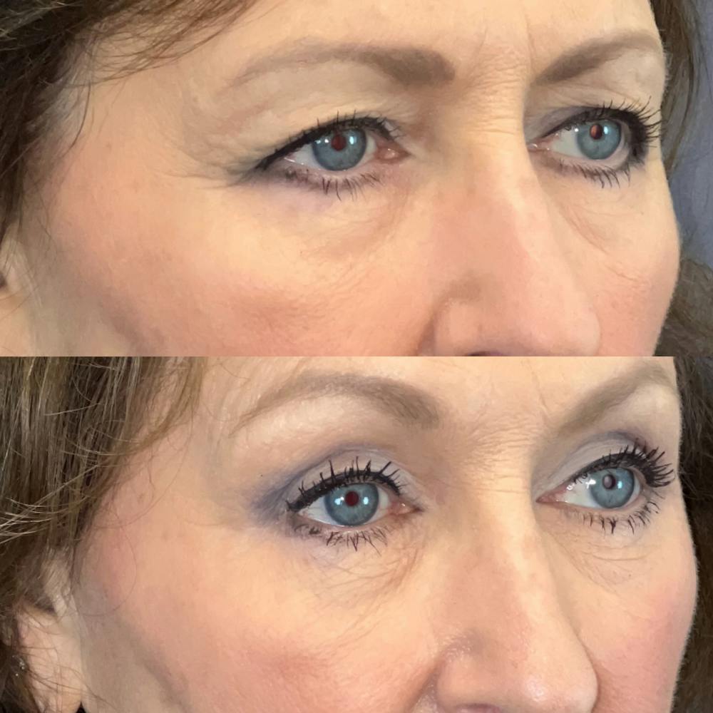 Brow Lift Before & After Gallery - Patient 179370234 - Image 2