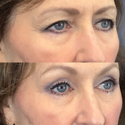 Brow Lift Before & After Gallery - Patient 179370234 - Image 2