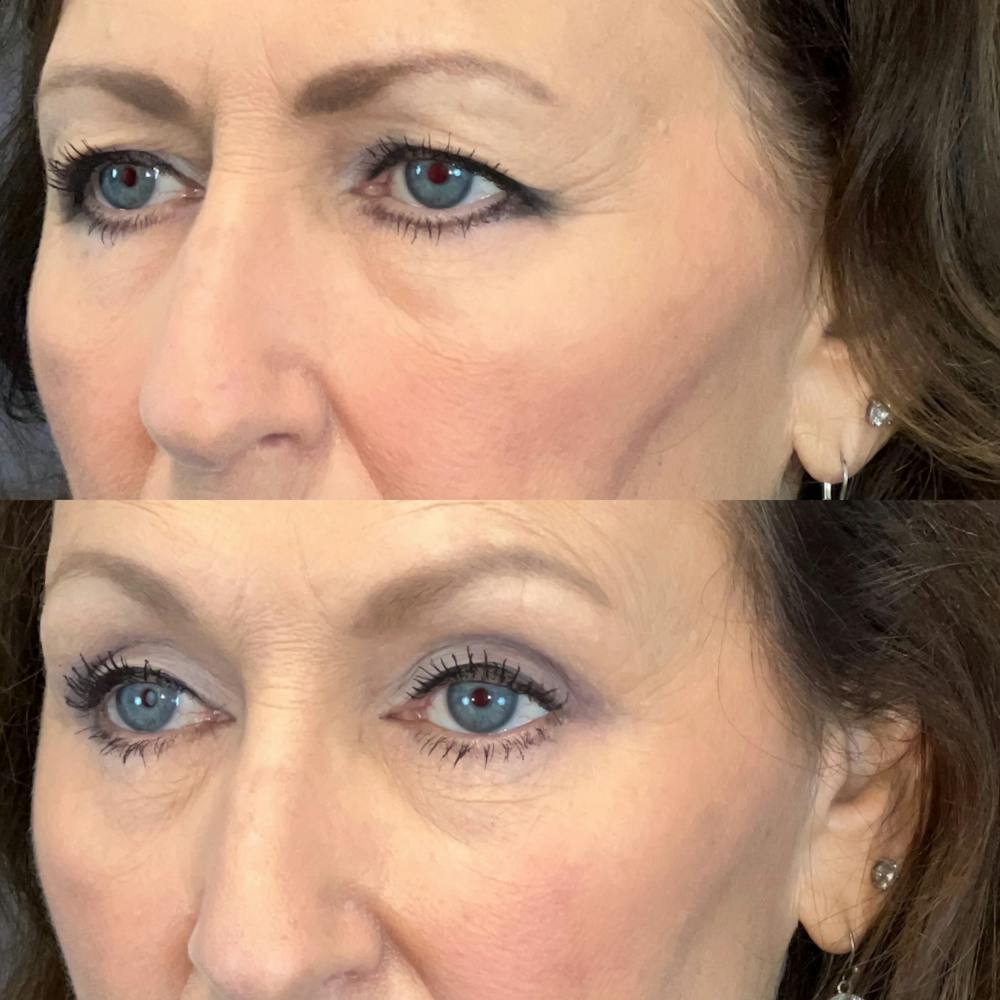 Brow Lift Before & After Gallery - Patient 179370234 - Image 3