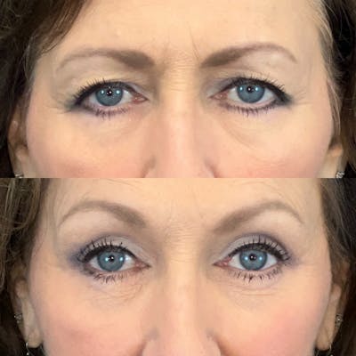 Brow Lift Before & After Gallery - Patient 179370234 - Image 1