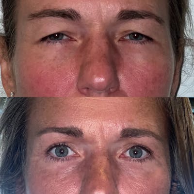 Upper Blepharoplasty Before & After Gallery - Patient 188317497 - Image 1