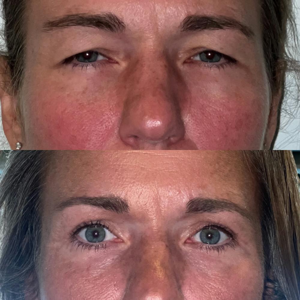 Upper Blepharoplasty Before & After Gallery - Patient 188317497 - Image 1