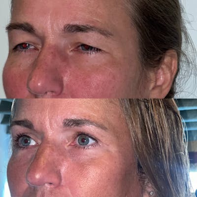 Upper Blepharoplasty Before & After Gallery - Patient 188317497 - Image 2