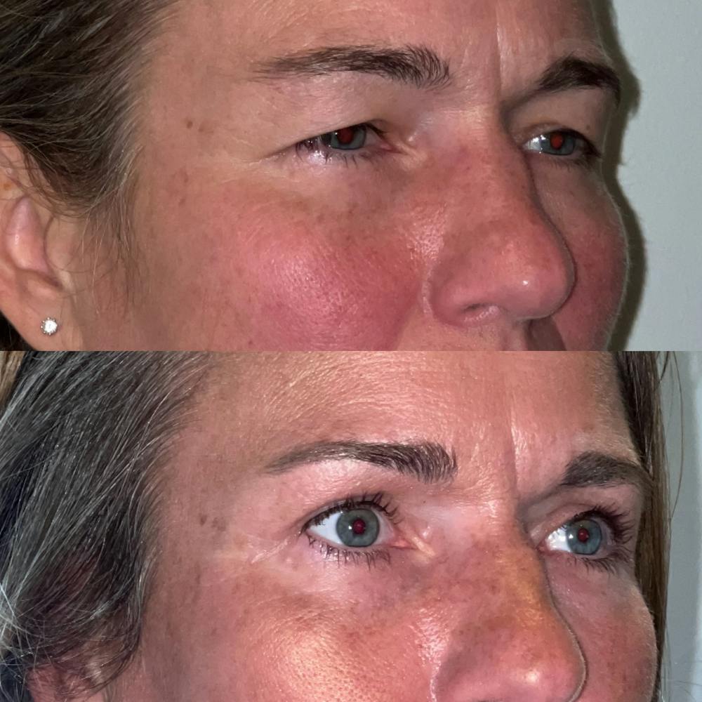Upper Blepharoplasty Before & After Gallery - Patient 188317497 - Image 3