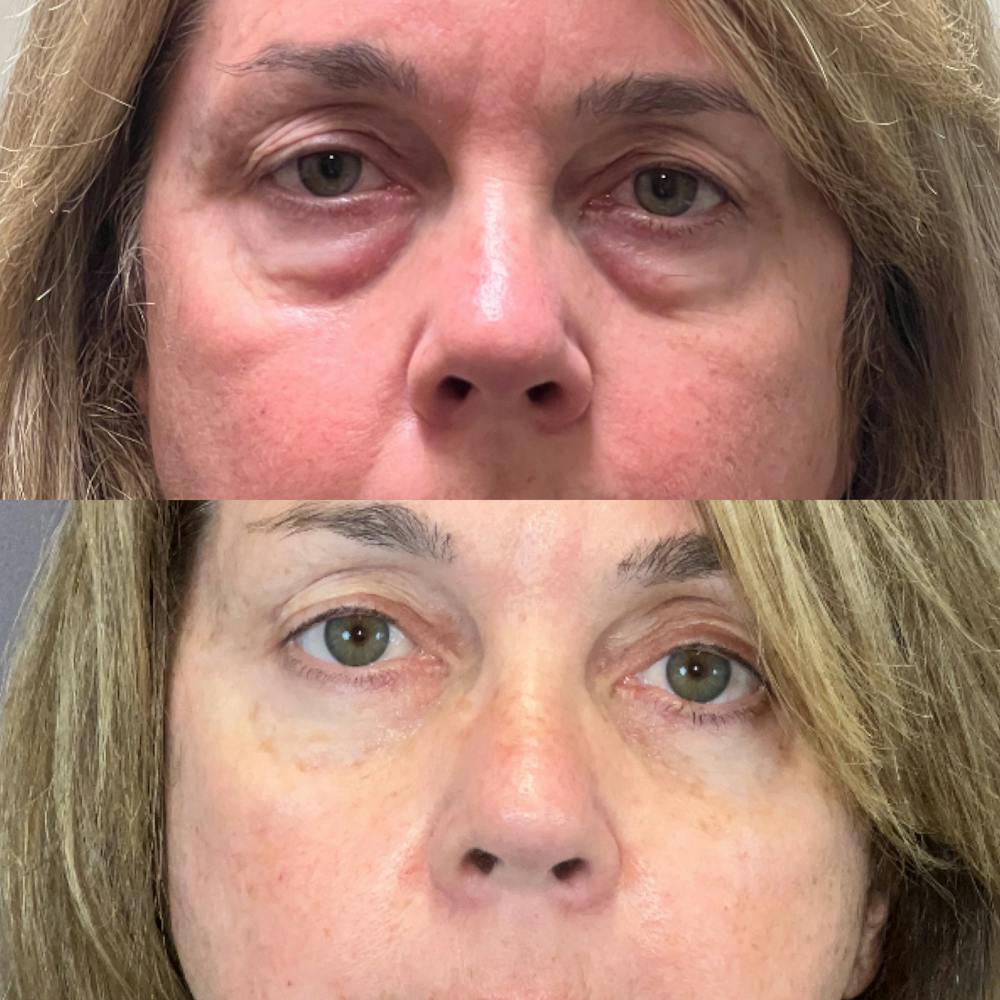 Upper Blepharoplasty Before & After Gallery - Patient 189828170 - Image 1