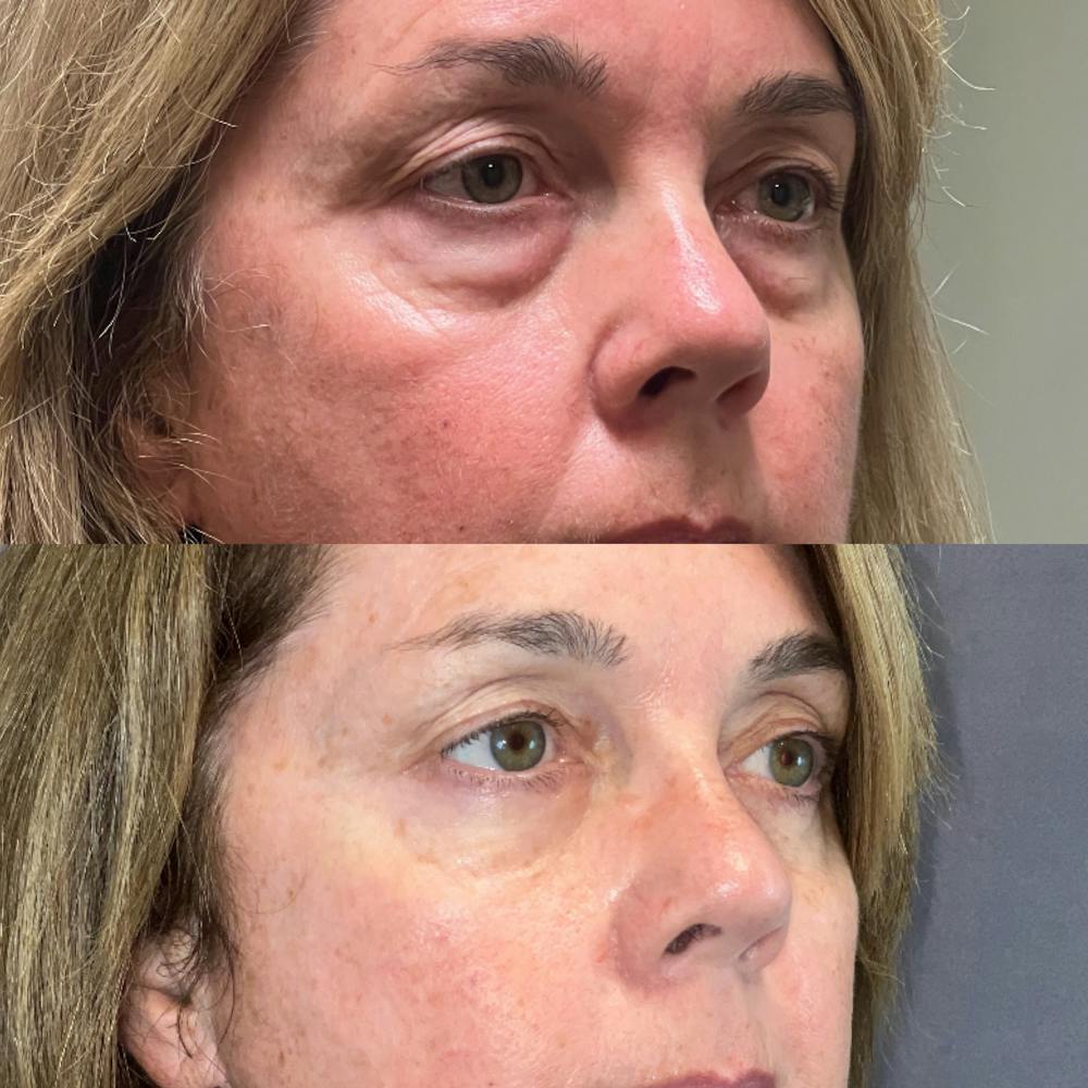Upper Blepharoplasty Before & After Gallery - Patient 189828170 - Image 2