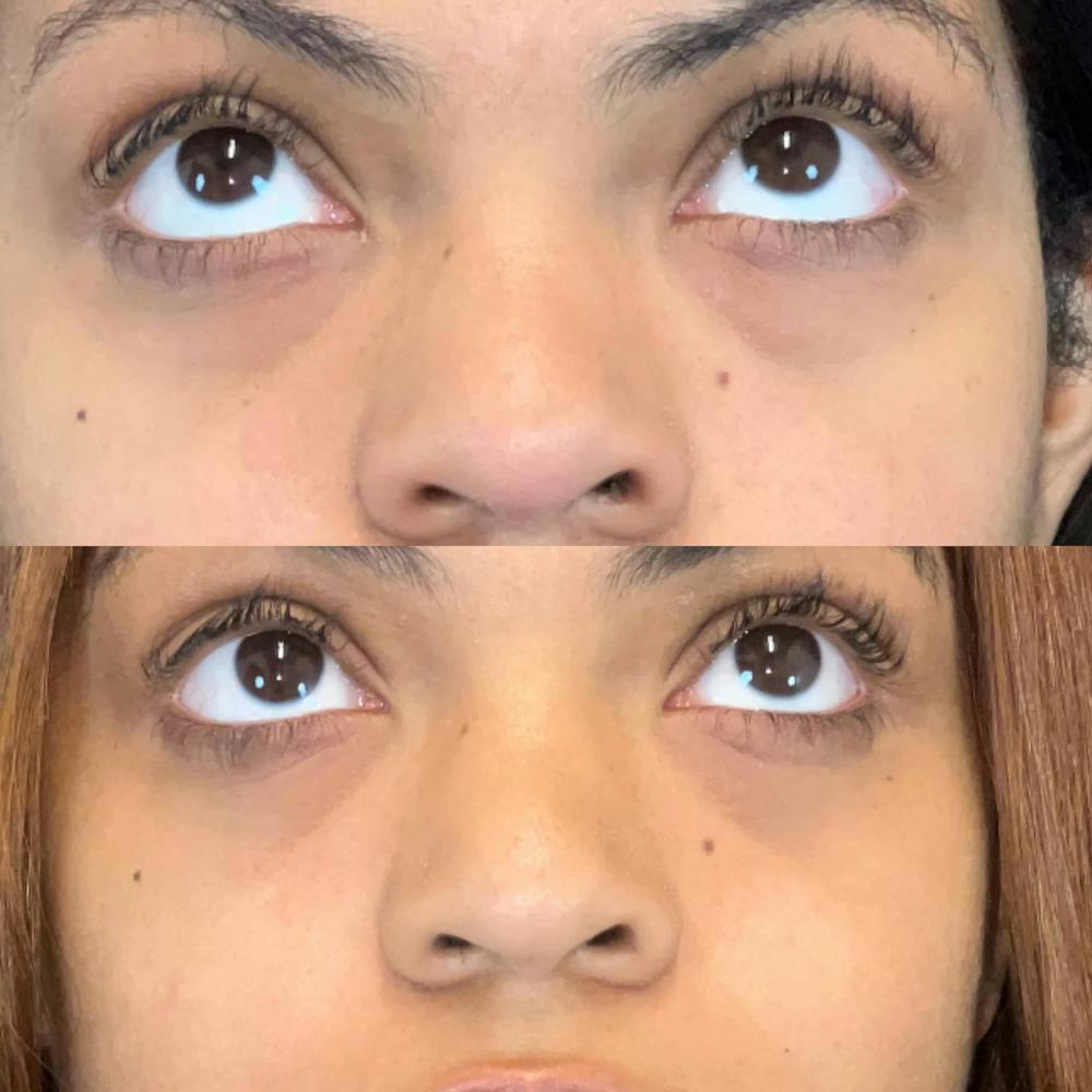 Lower Blepharoplasty Before & After Gallery - Patient 321440 - Image 2
