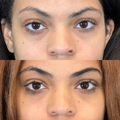 Lower Blepharoplasty Before & After Gallery - Patient 321440 - Image 1
