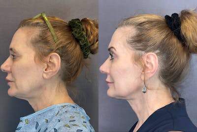 Lower Blepharoplasty Before & After Gallery - Patient 141740 - Image 2