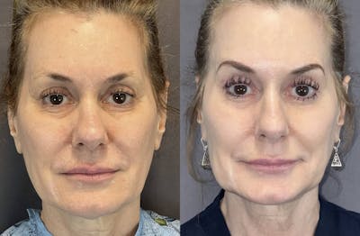 Lower Blepharoplasty Before & After Gallery - Patient 141740 - Image 1