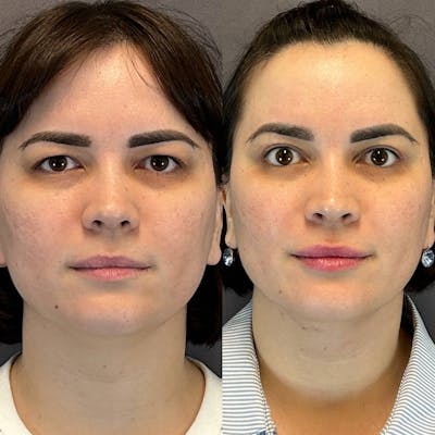 Upper Blepharoplasty Before & After Gallery - Patient 308387 - Image 1