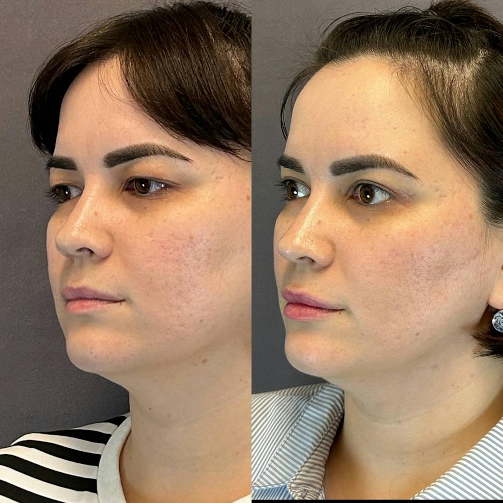 Sciton Moxi Laser Before & After Gallery - Patient 361200 - Image 2