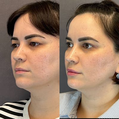 Upper Blepharoplasty Before & After Gallery - Patient 308387 - Image 2