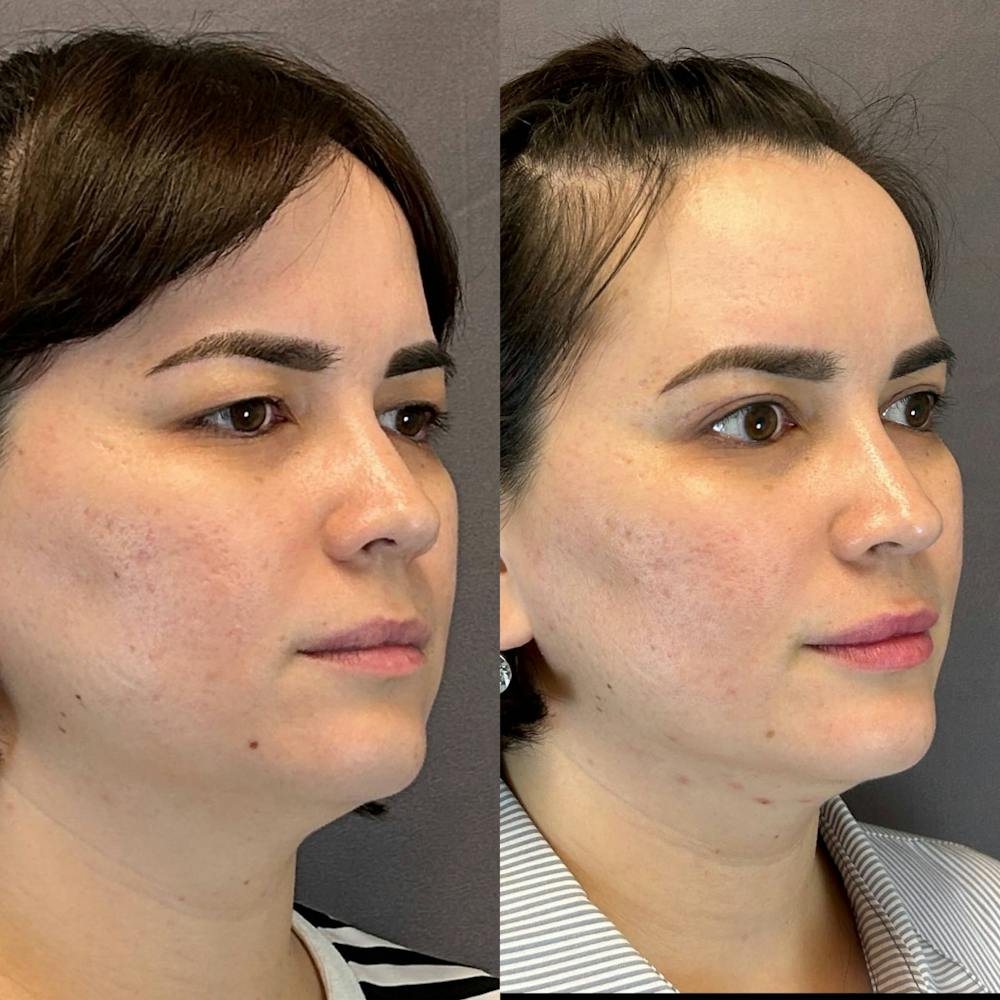 Brow Lift Before & After Gallery - Patient 774412 - Image 3