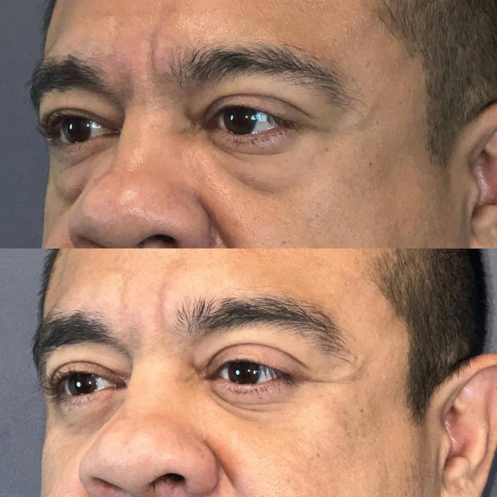 Lower Blepharoplasty Before & After Gallery - Patient 422830 - Image 3