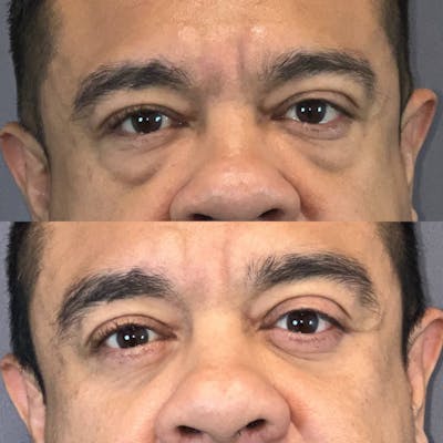 Lower Blepharoplasty Before & After Gallery - Patient 422830 - Image 1