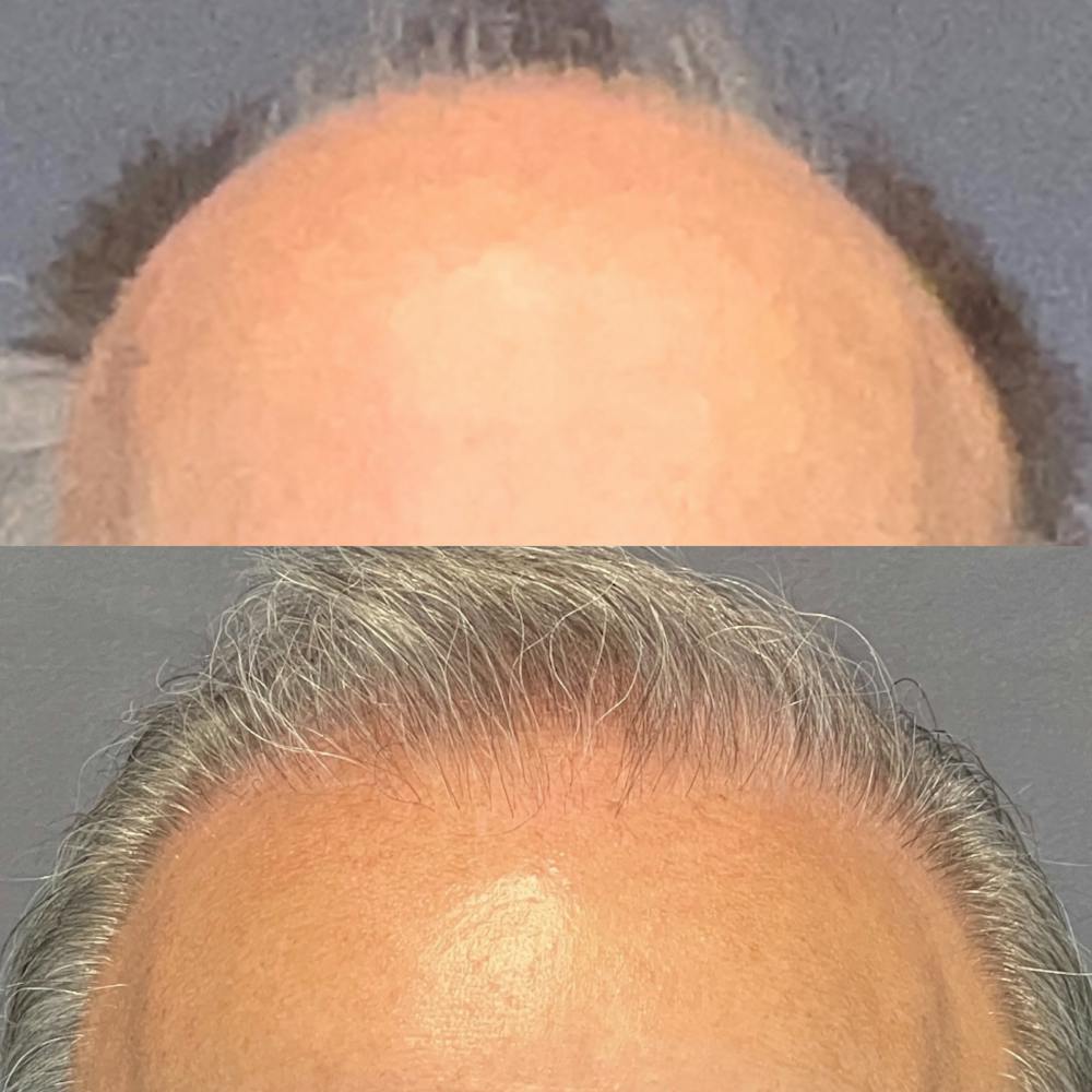 Hair Restoration  Before & After Gallery - Patient 574074 - Image 1