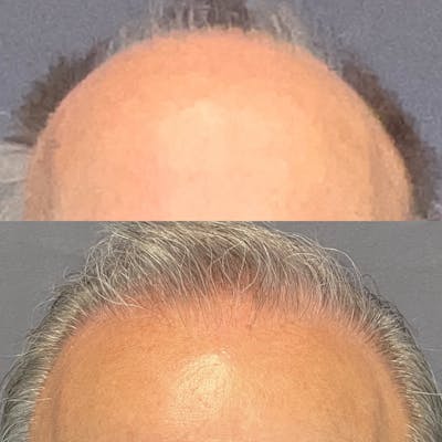 Hair Restoration  Before & After Gallery - Patient 574074 - Image 1
