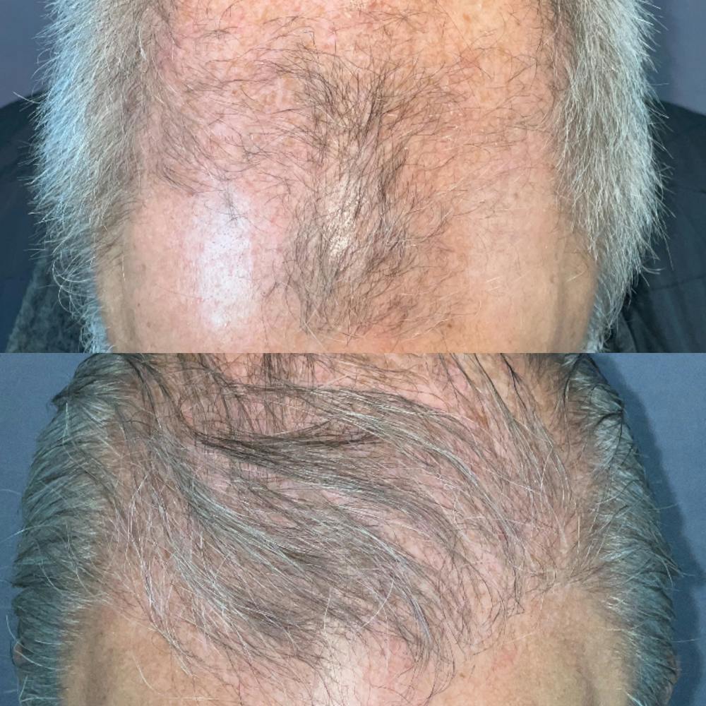 Hair Restoration  Before & After Gallery - Patient 574074 - Image 2