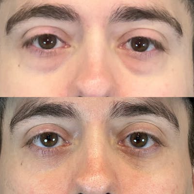 Lower Blepharoplasty Before & After Gallery - Patient 177940 - Image 1