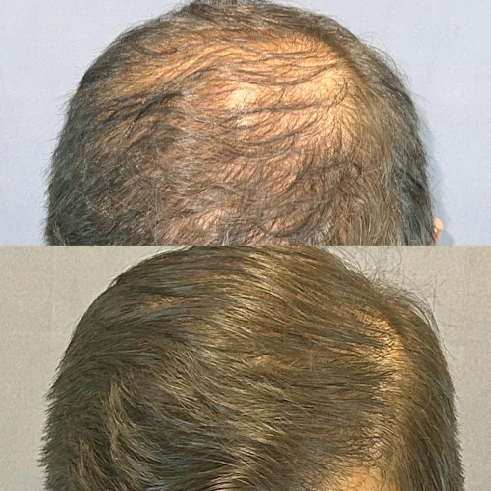 Hair Restoration  Before & After Gallery - Patient 850039 - Image 1