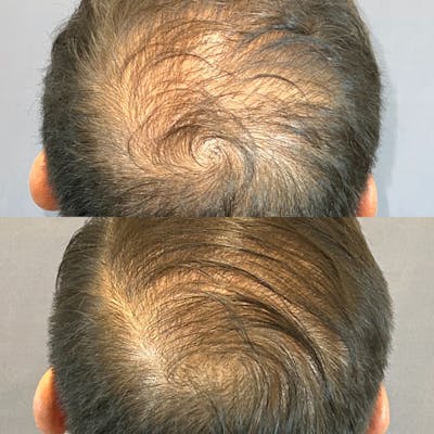 Hair Restoration  Before & After Gallery - Patient 850039 - Image 2