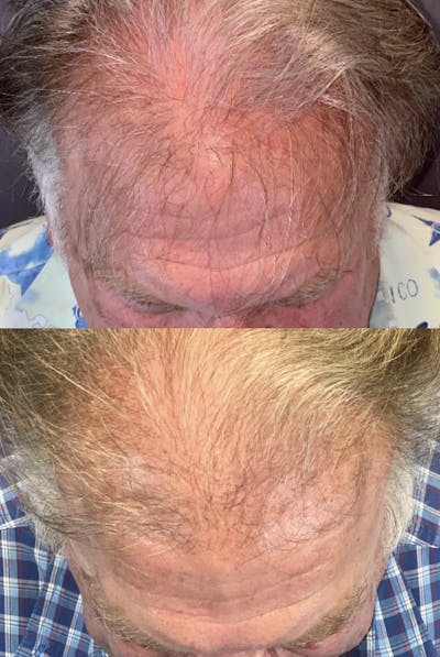 Hair Restoration  Before & After Gallery - Patient 403593 - Image 2