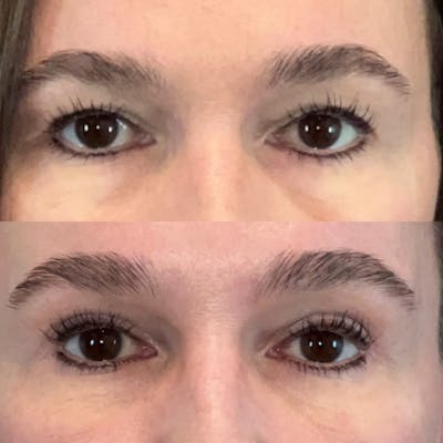 Upper Blepharoplasty Before & After Gallery - Patient 111384 - Image 1
