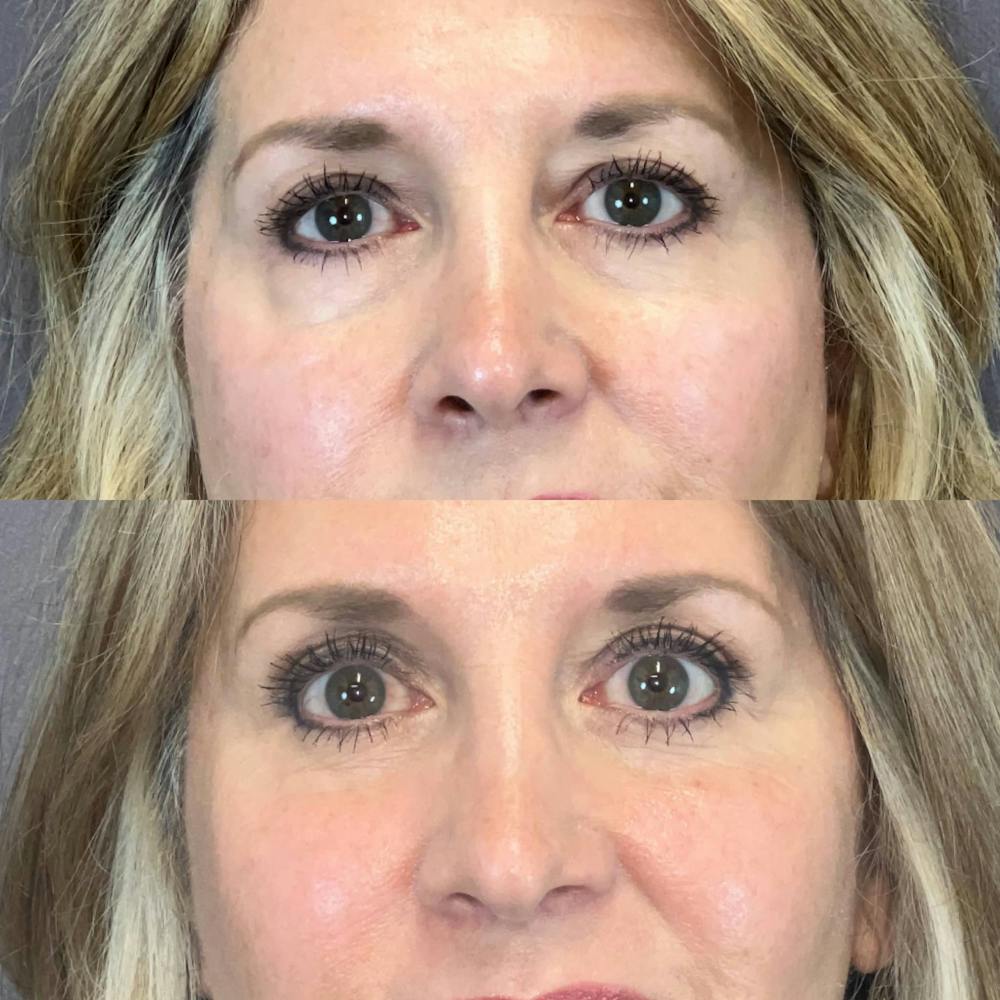 Lower Blepharoplasty Before & After Gallery - Patient 181552 - Image 1