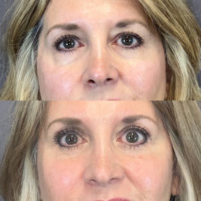 Brow Lift Before & After Gallery - Patient 690048 - Image 1