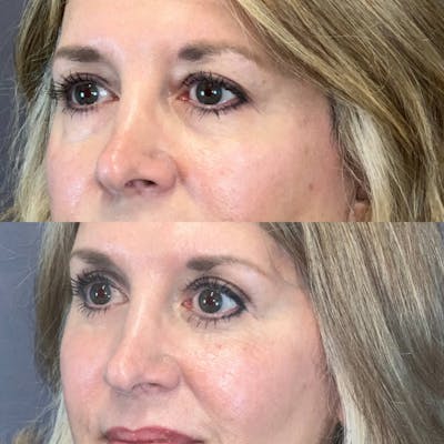 Brow Lift Before & After Gallery - Patient 690048 - Image 2