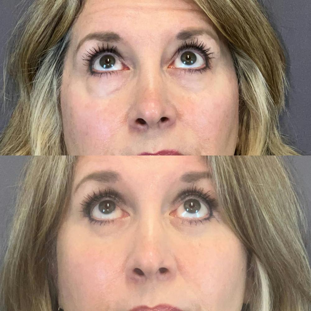 Brow Lift Before & After Gallery - Patient 690048 - Image 3