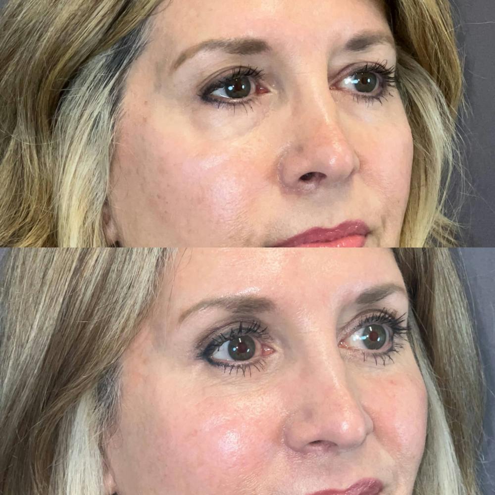 Laser Resurfacing Before & After Gallery - Patient 354981 - Image 4