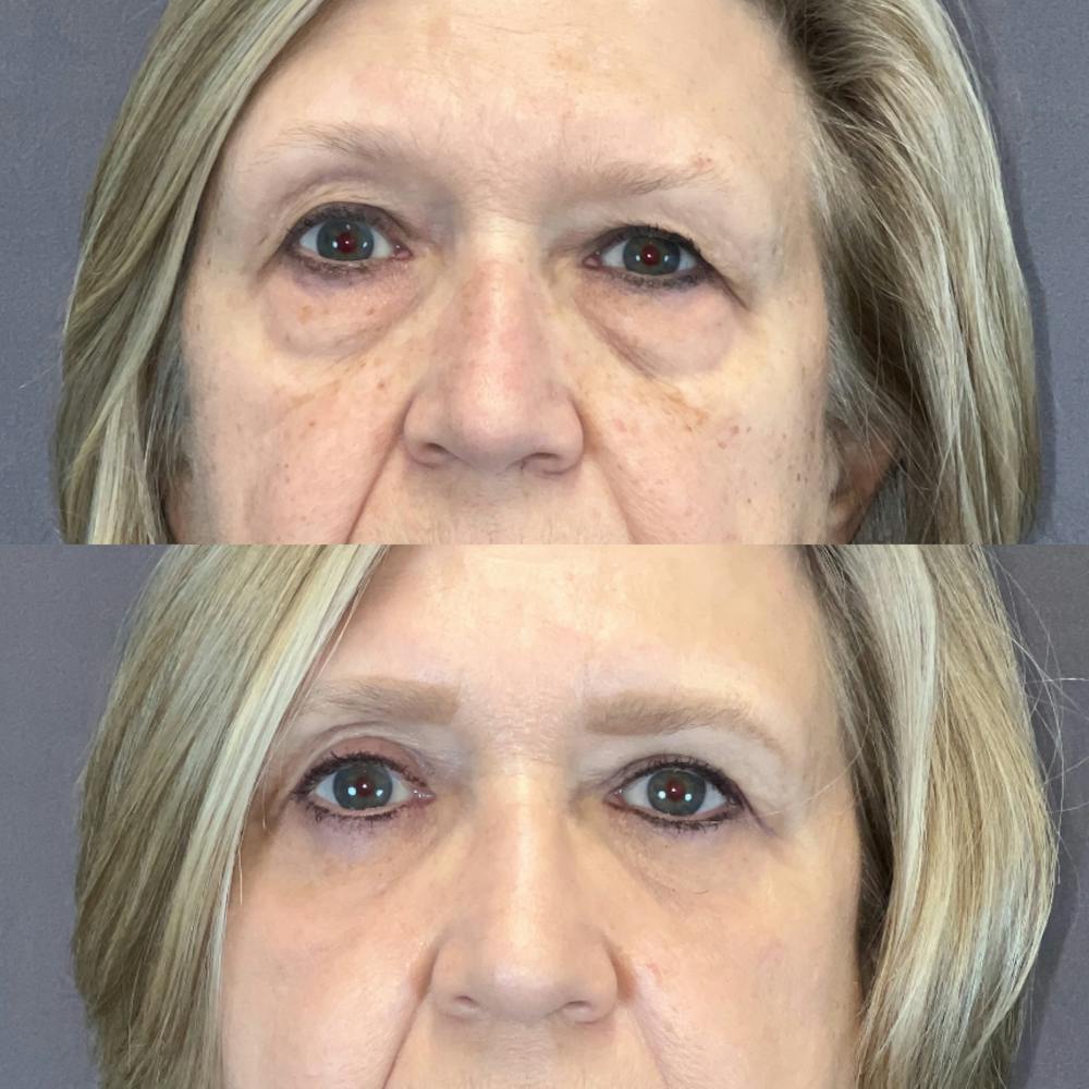 Upper Blepharoplasty Before & After Gallery - Patient 389417 - Image 1