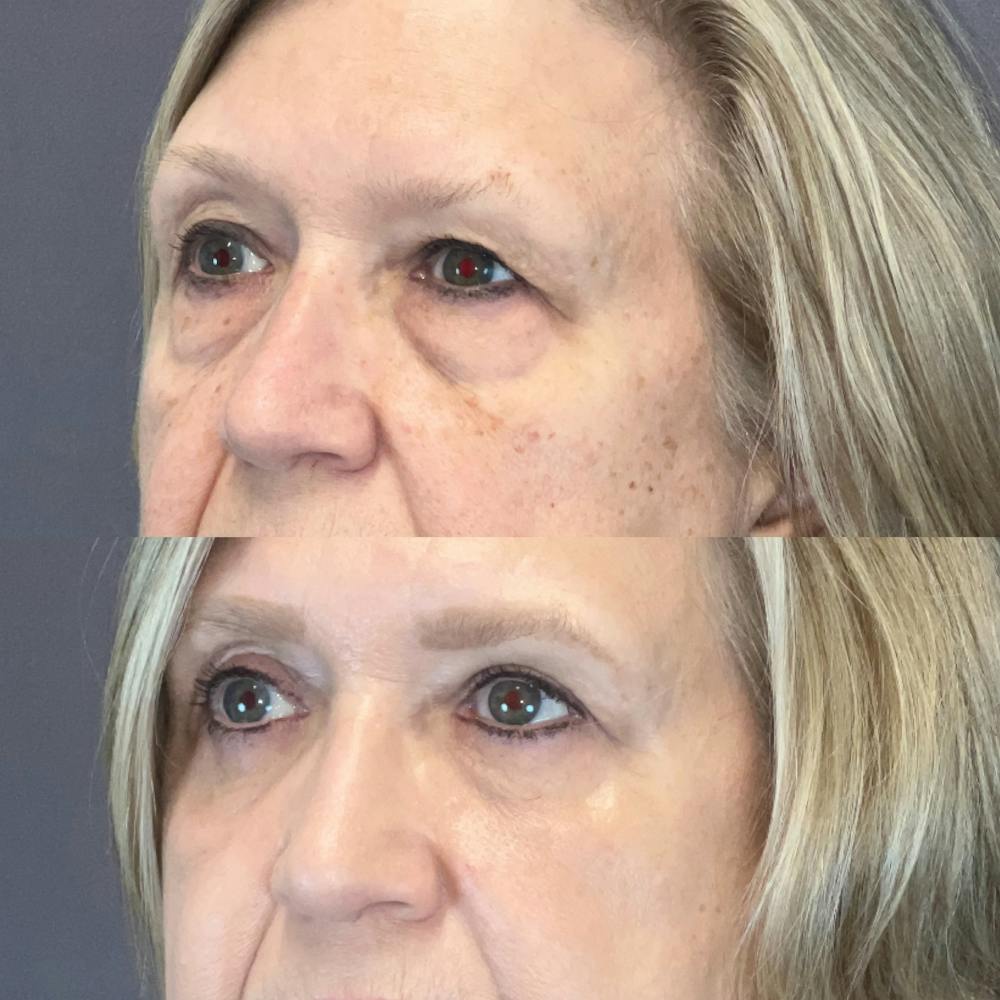 Laser Resurfacing Before & After Gallery - Patient 278273 - Image 2